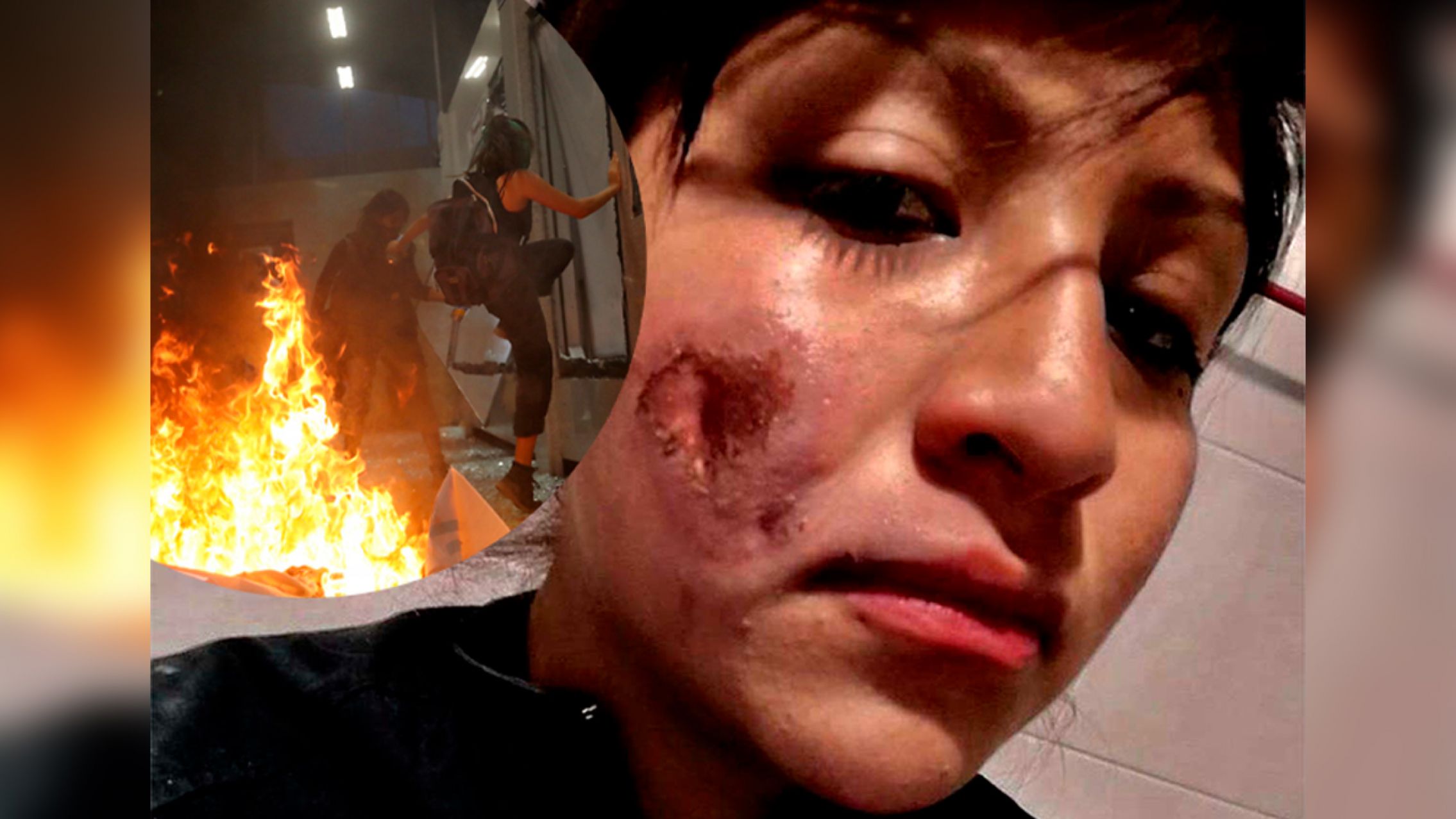 "Feministas" quemaron el rostro de mujer policía: No he matado ni violado a nadie