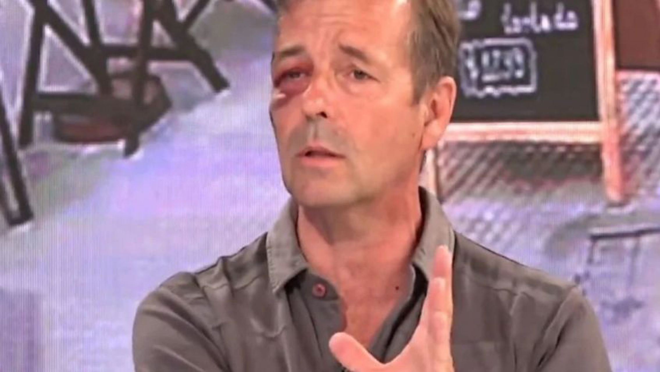 El periodista de canal América que reapareció con su rostro desfigurado tras sufrir un robo