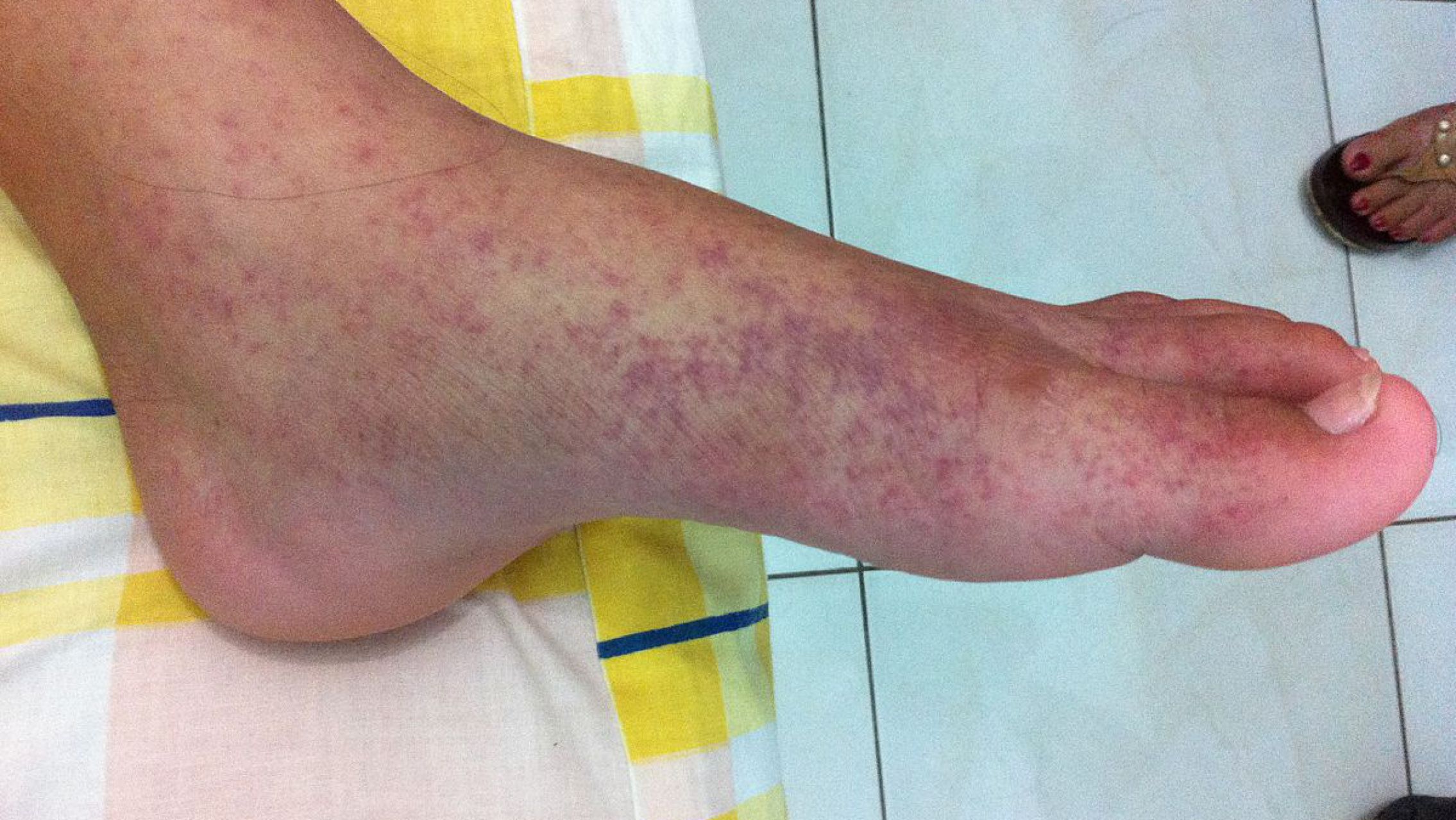 Paraguay en alerta: acumula más de 24 mil casos de chikunguya