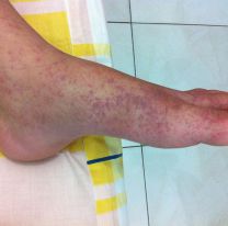 Paraguay en alerta: acumula más de 24 mil casos de chikunguya