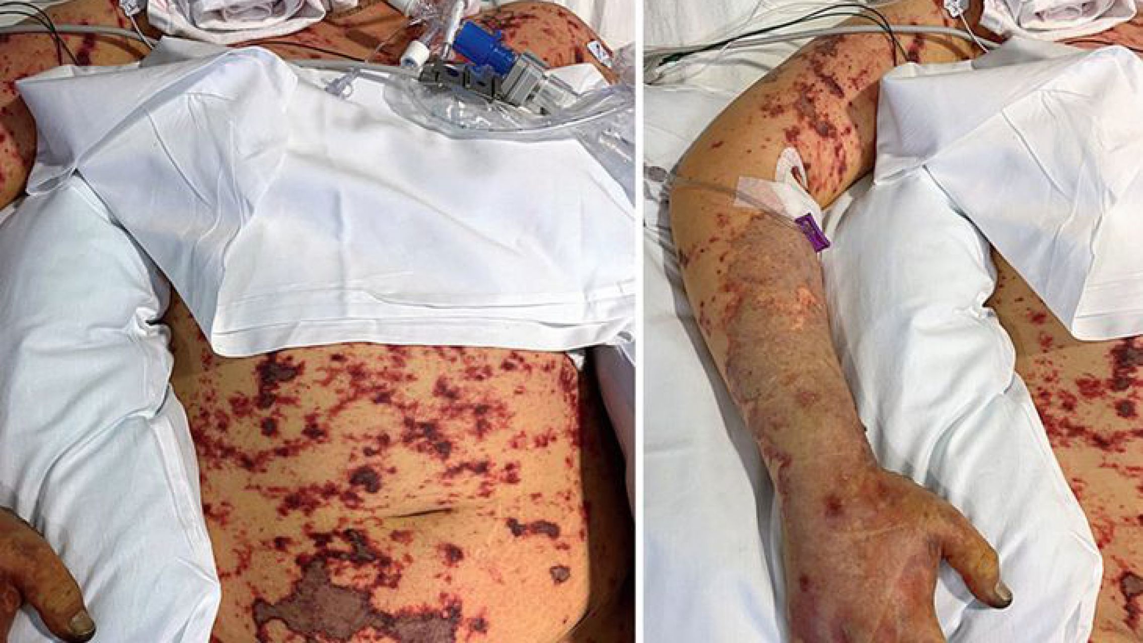 Amputan piernas a joven después de comer comida china en mal estado