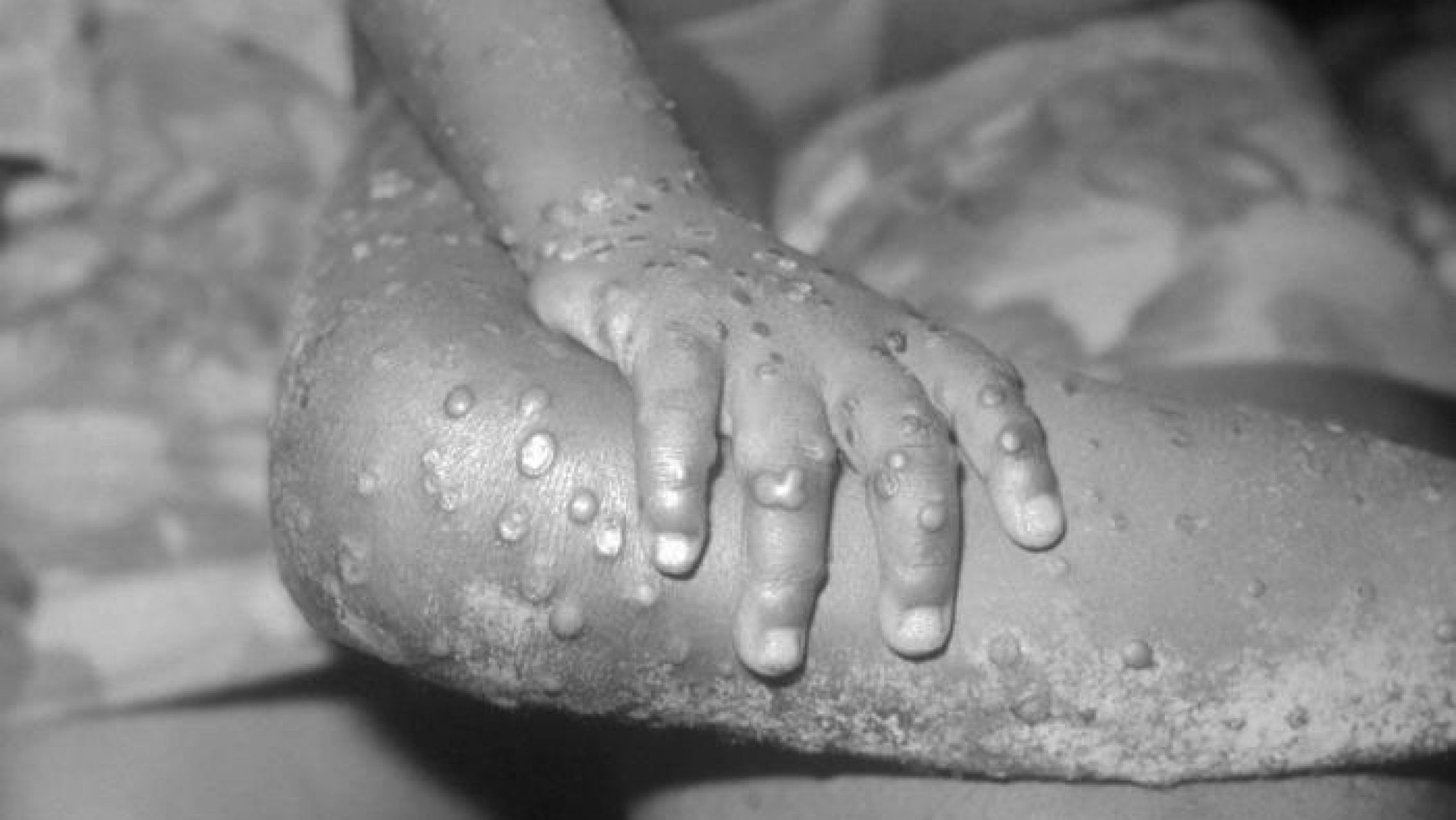 Confirmaron la primera muerte por mpox (viruela símica) en la Argentina