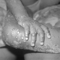Confirmaron la primera muerte por mpox (viruela s&iacute;mica) en la Argentina