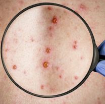 Viruela símica: Confirman el tercer caso en el país, el primero sin antecedentes de viaje