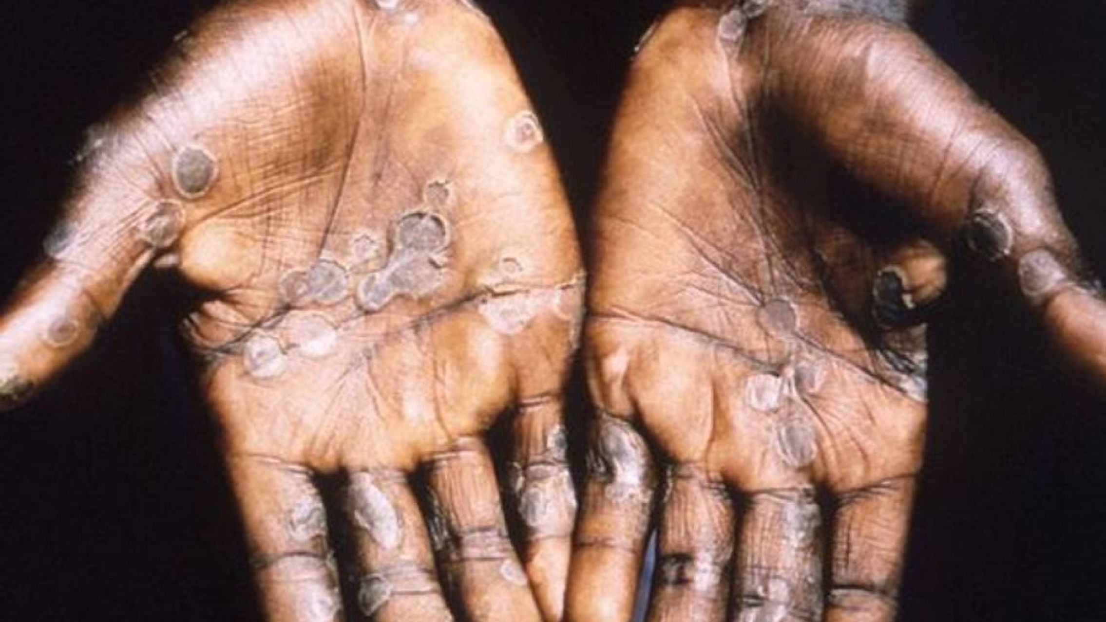 Diez cosas que hay que saber sobre la viruela símica o "del mono" tras confirmarse el segundo caso en el interior