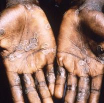 Diez cosas que hay que saber sobre la viruela símica o "del mono" tras confirmarse el segundo caso en el interior