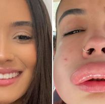 Se puso relleno en los labios y tuvo una reacción que le dejó la cara deformada